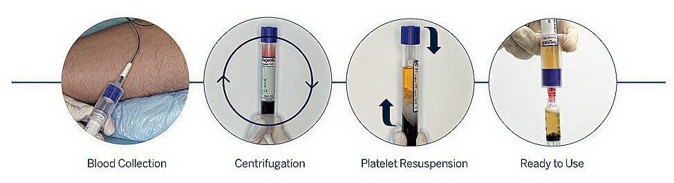 Blood processing steps for therapeutic use.