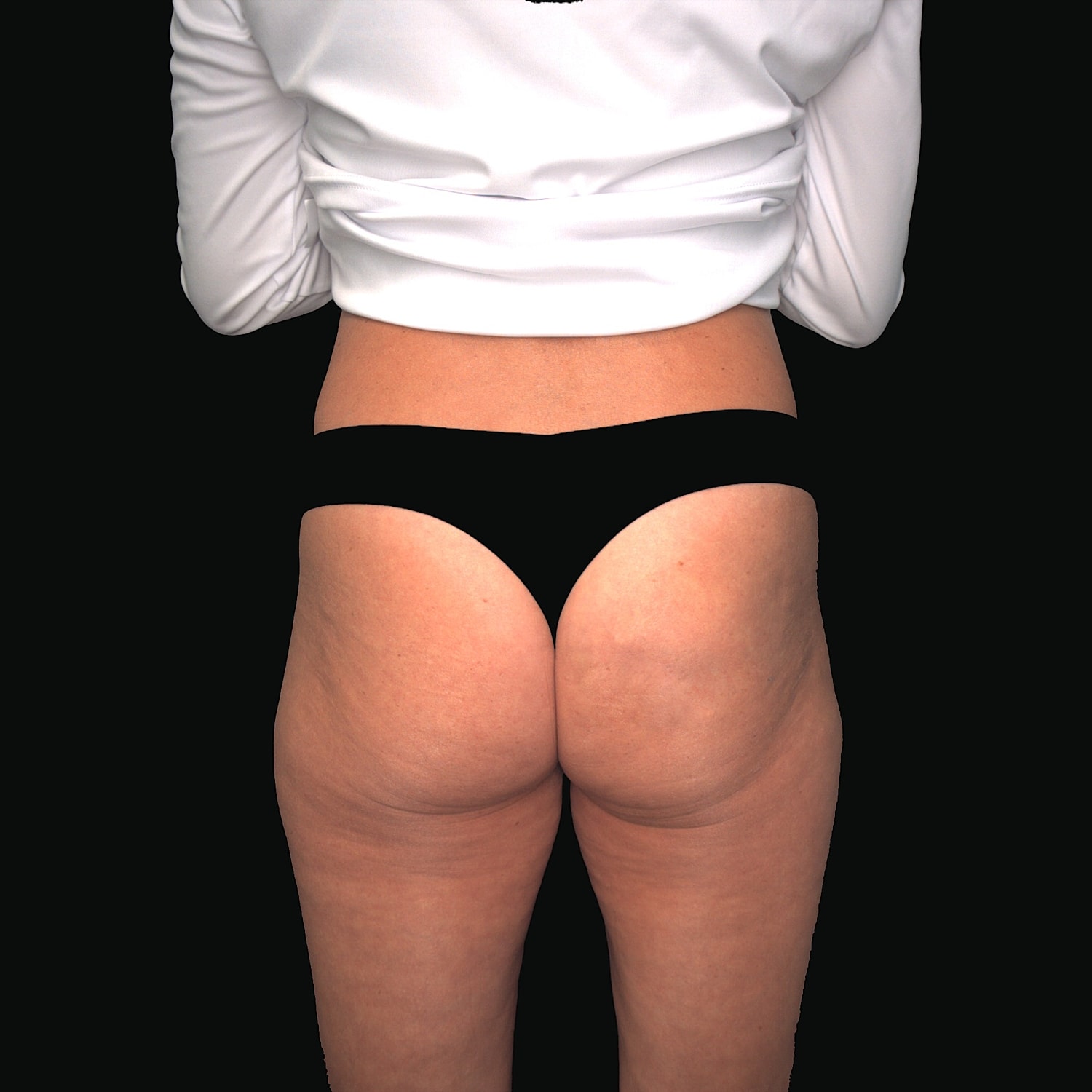 After alloclae treatment