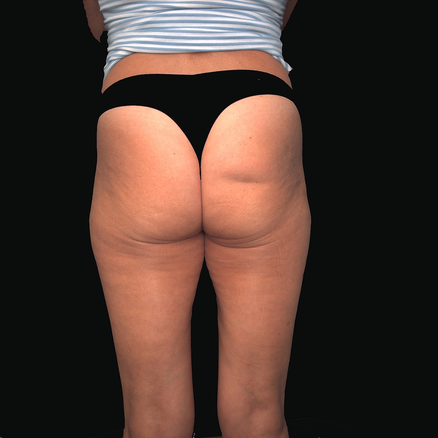 Before alloclae treatment, person buttocks