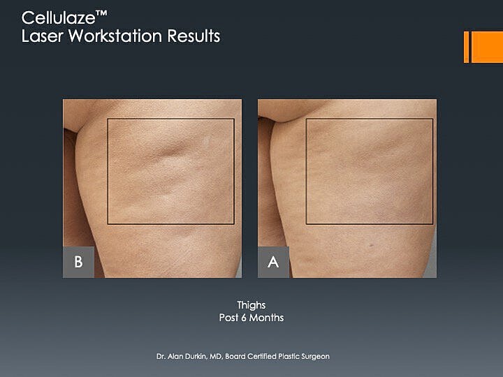Cellulaze laser treatment results on thighs, six months.