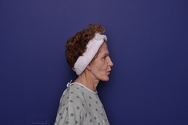 Woman in hospital gown against purple background.