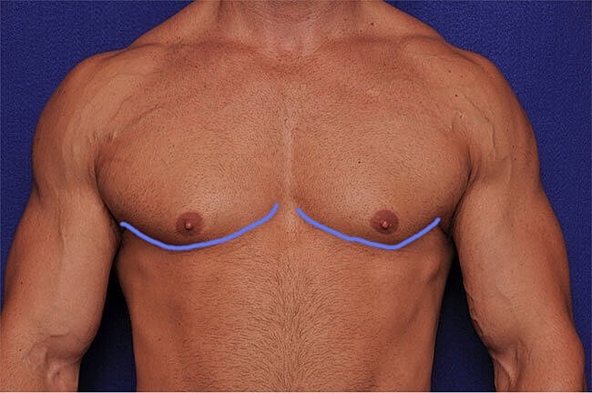 Chest contouring illustration with lines drawn.