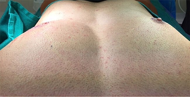 Surgical view of a patient's bare back.