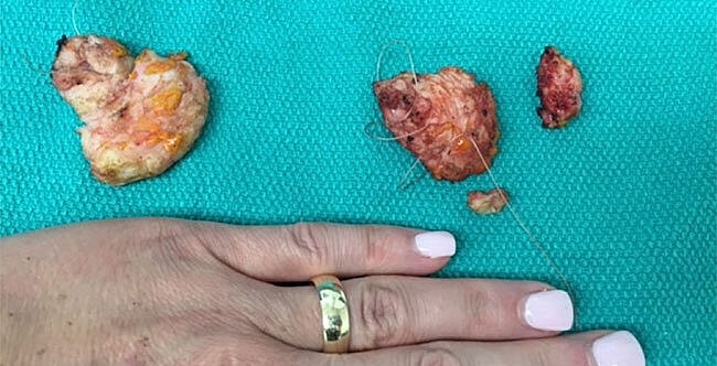 Removed tissue samples next to a hand.