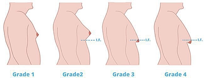 Breast shape classification by grade.