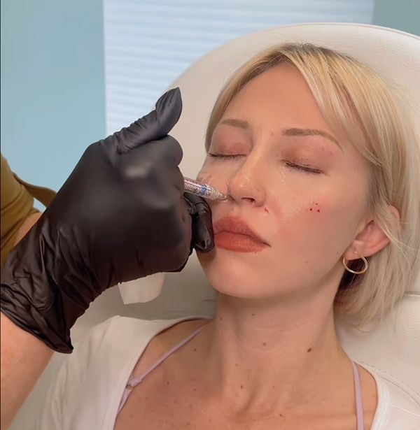 Injecting cosmetic filler on a client's face.