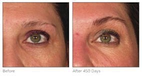 Eyebrow transformation before and after 450 days.