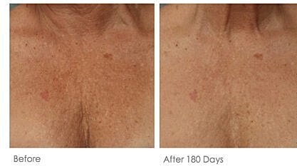 Skin improvement after 180 days of treatment.