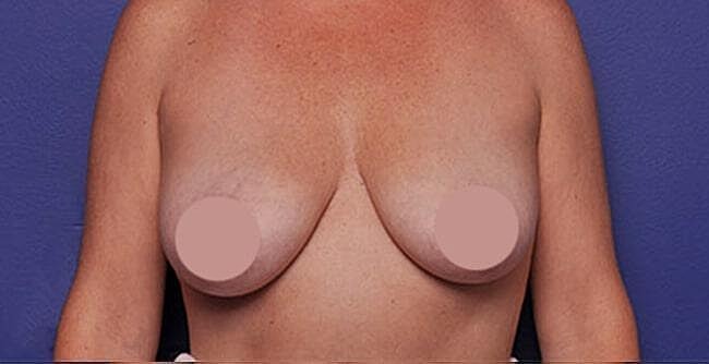 Breast Lift With Augmentation Before & After