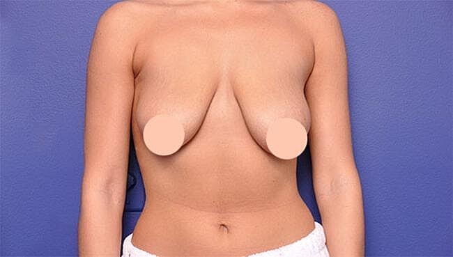 Breast Lift With Augmentation Before & After