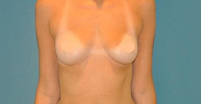 Breast Lift With Augmentation Before & After