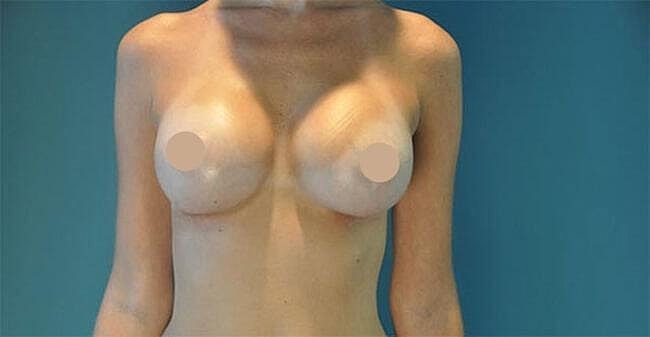 Breast Lift With Augmentation Before & After