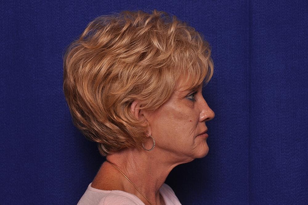 Renuva Before & After