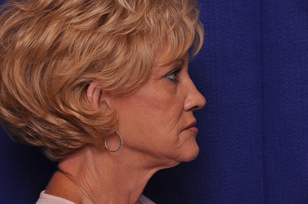 Renuva Before & After