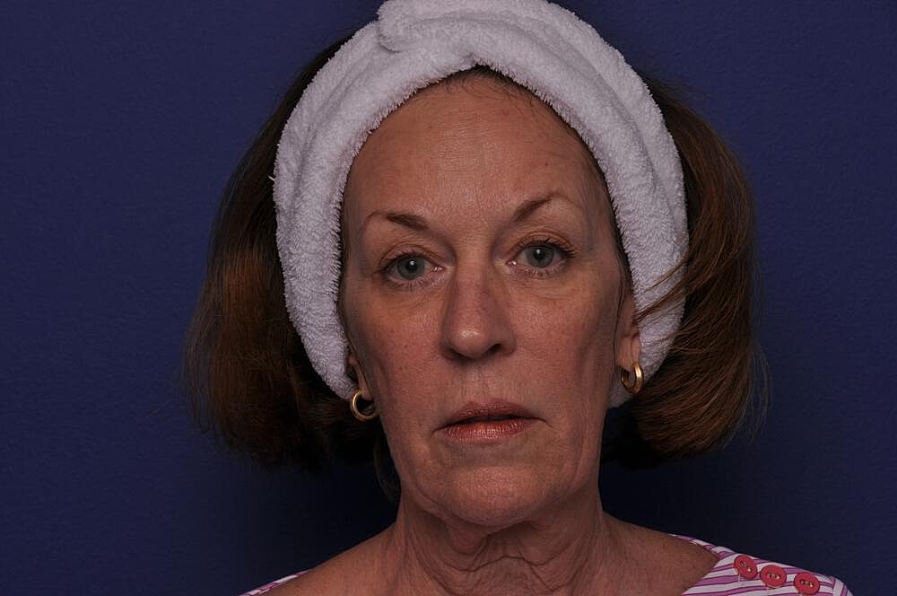 Renuva Before & After