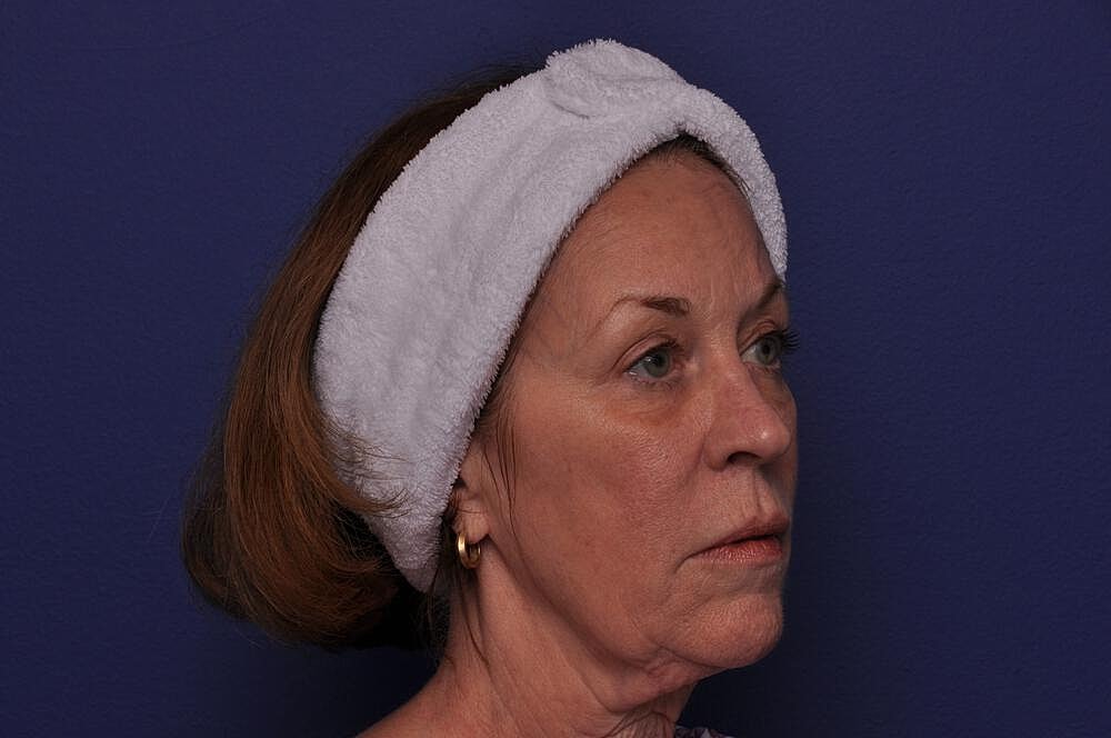 Renuva Before & After