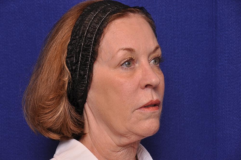 Renuva Before & After