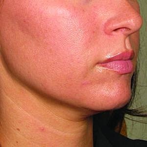 Ultherapy Before & After