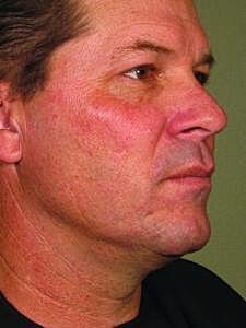 Ultherapy Before & After