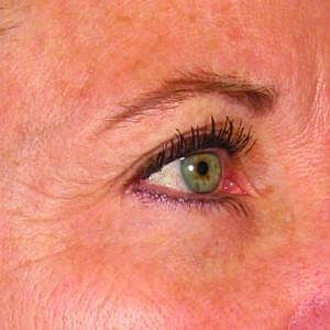 Ultherapy Before & After