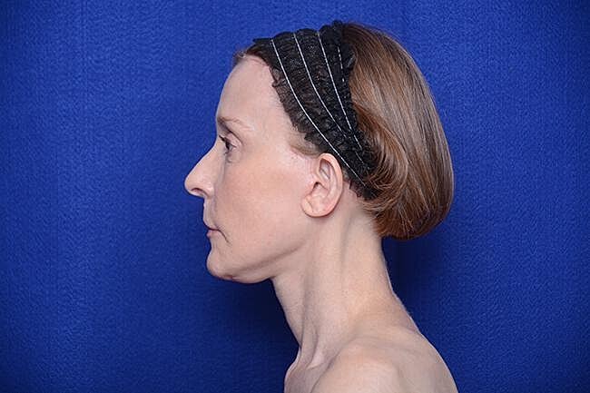 Brow Lift Before & After