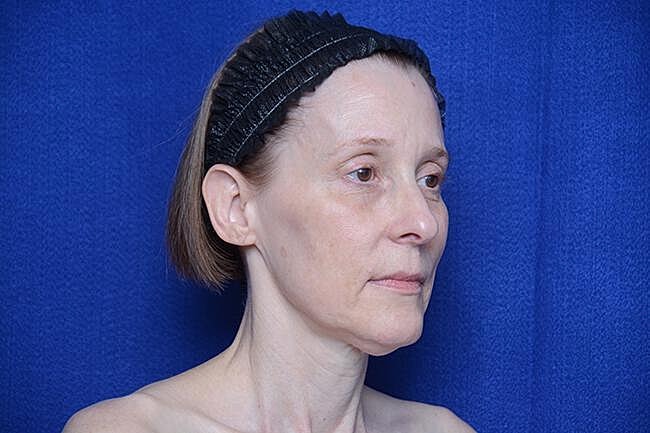 Brow Lift Before & After