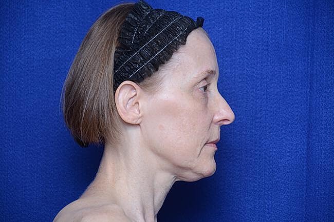 Brow Lift Before & After