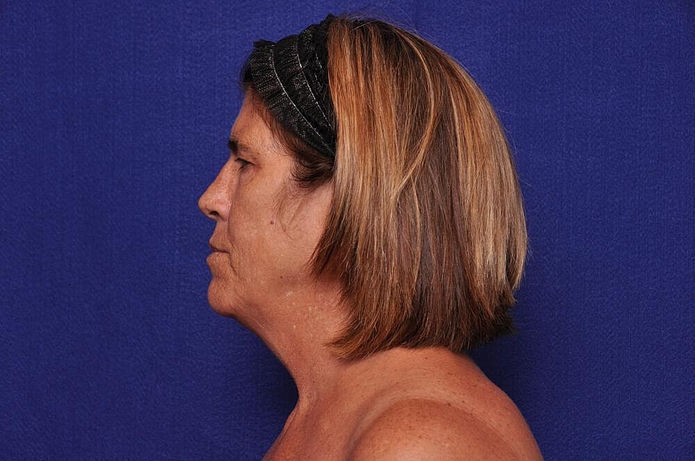 Brow Lift Before & After