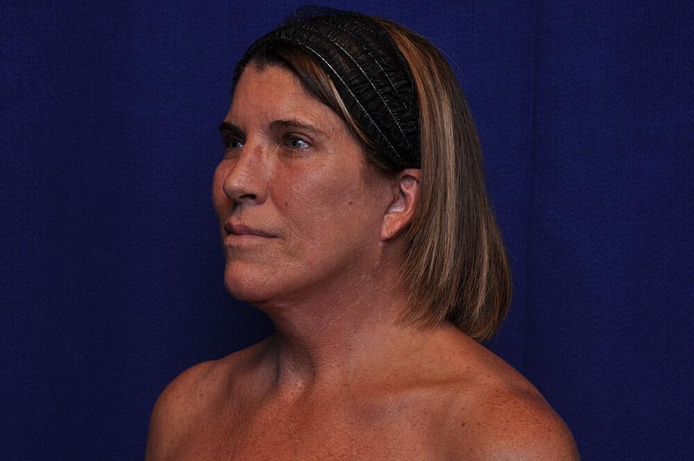 Brow Lift Before & After