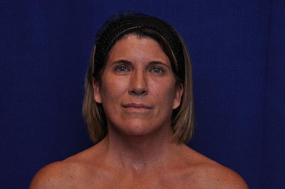 Brow Lift Before & After