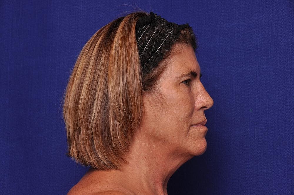 Brow Lift Before & After