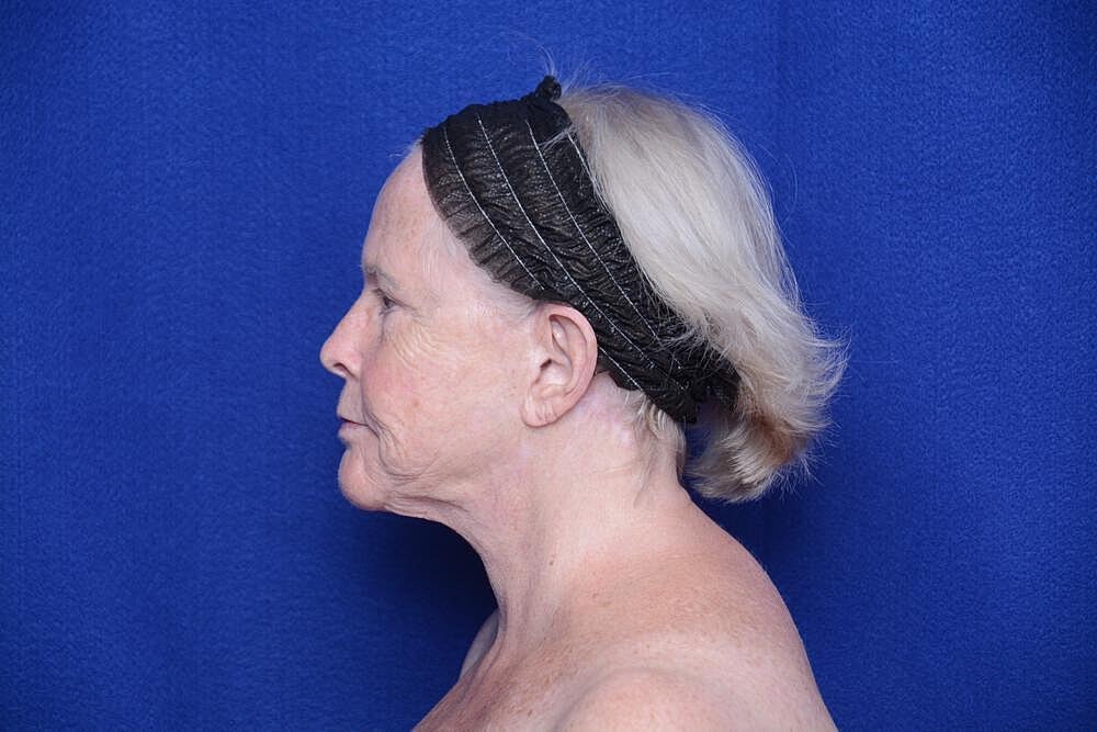 Brow Lift Before & After