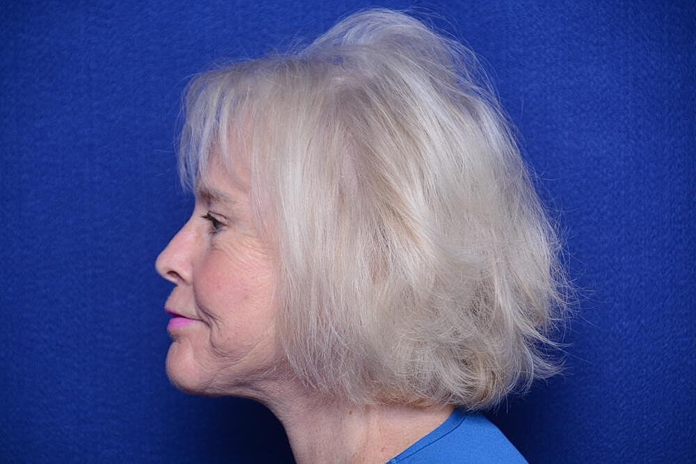 Brow Lift Before & After