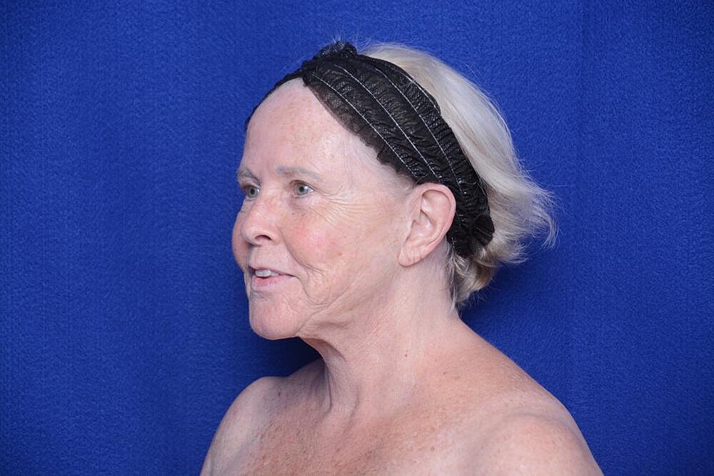 Brow Lift Before & After