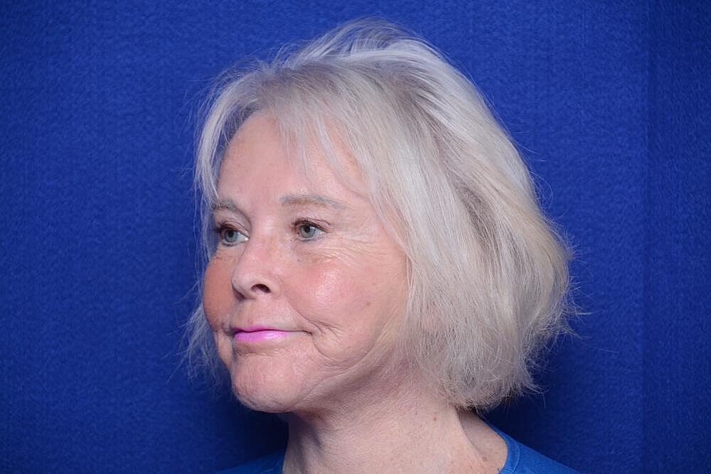 Brow Lift Before & After