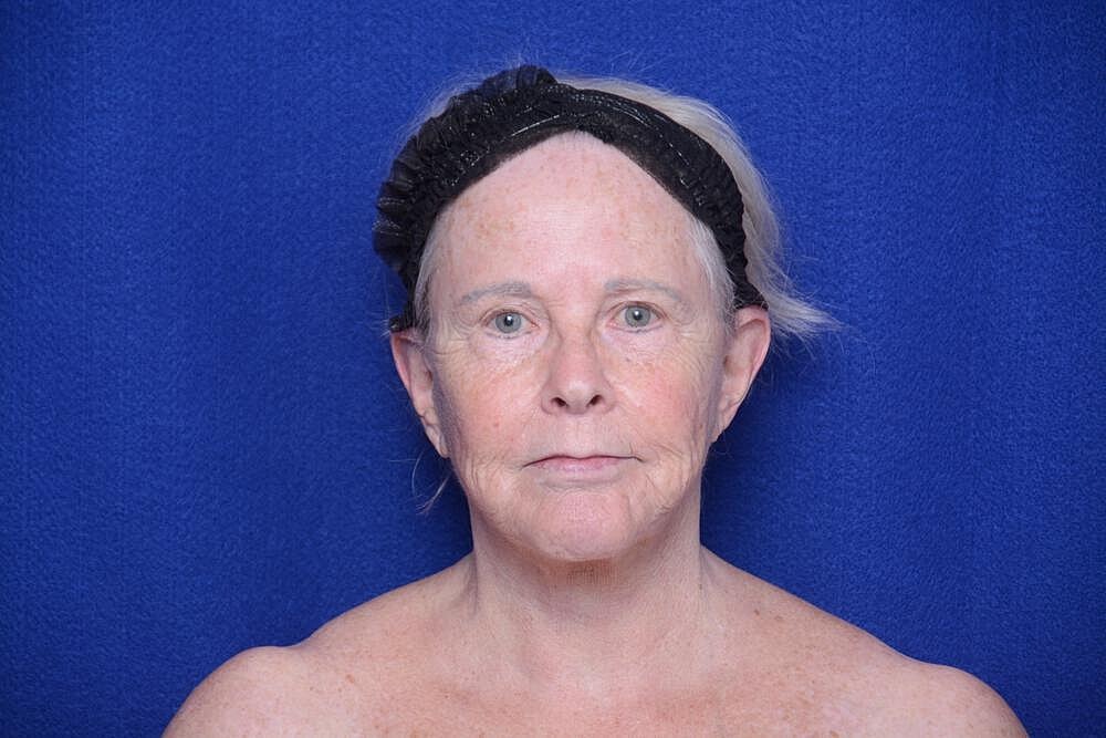 Brow Lift Before & After