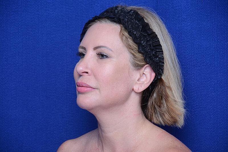 Chin Implant Before & After