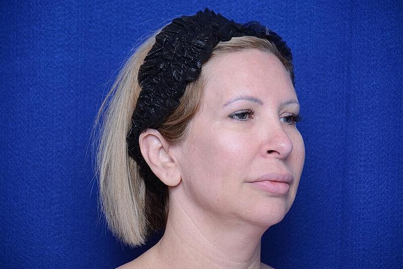 Chin Implant Before & After