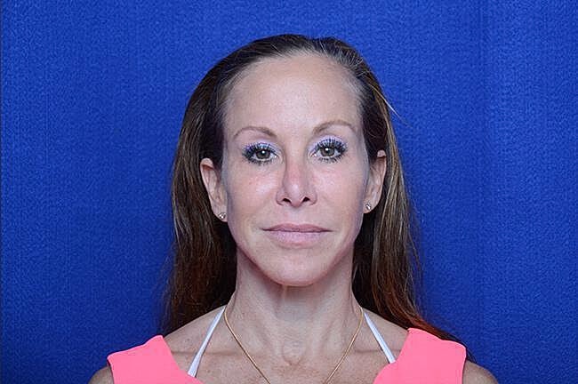 Xeomin Before & After