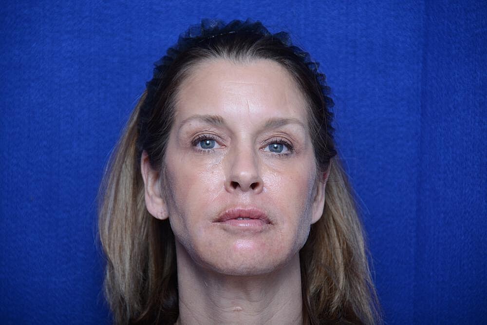 Liquid Facelift Before & After