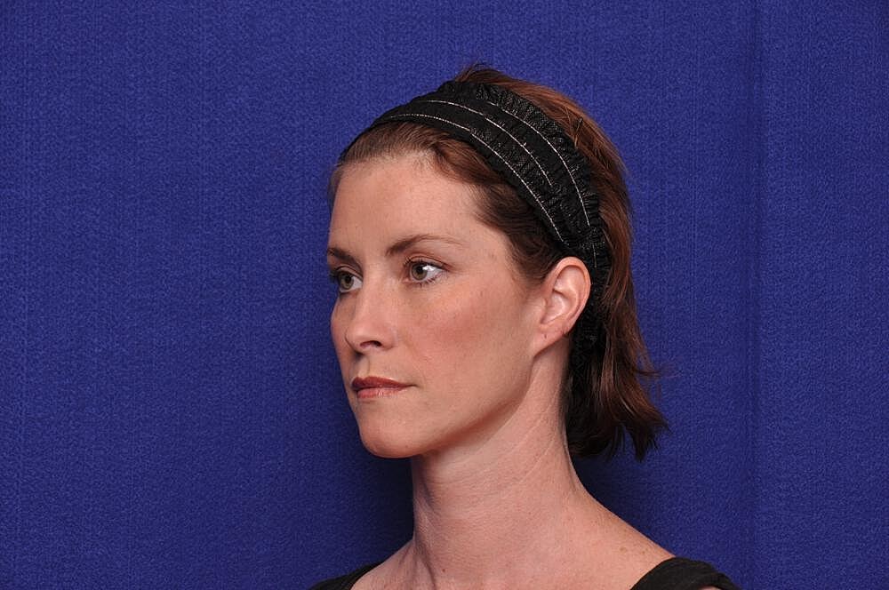 Liquid Facelift Before & After