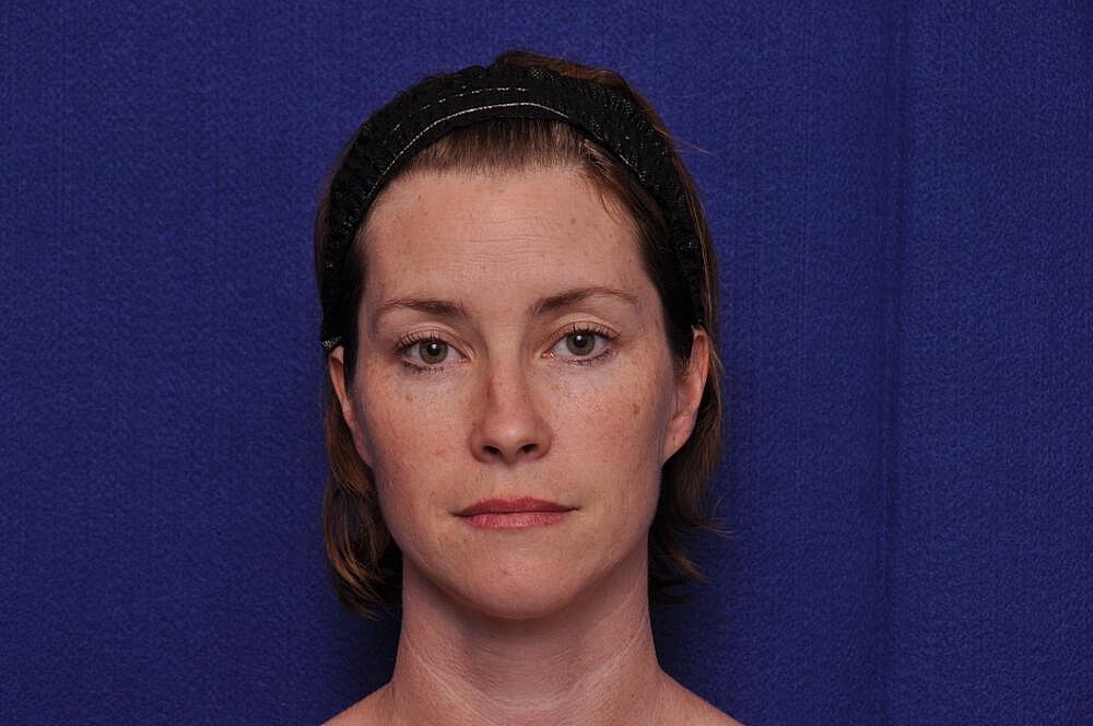 Liquid Facelift Before & After