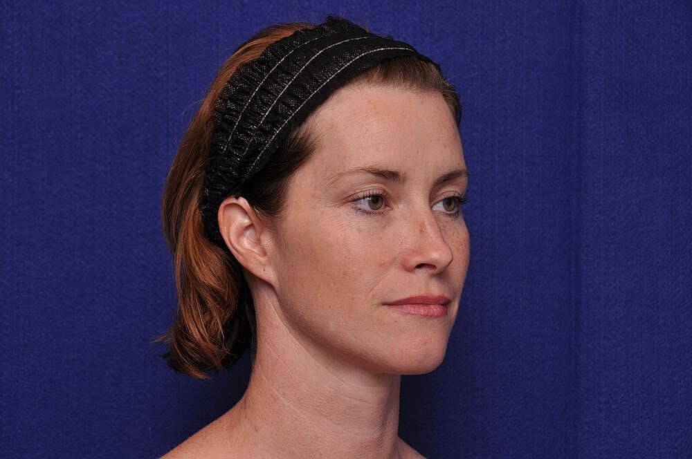 Liquid Facelift Before & After