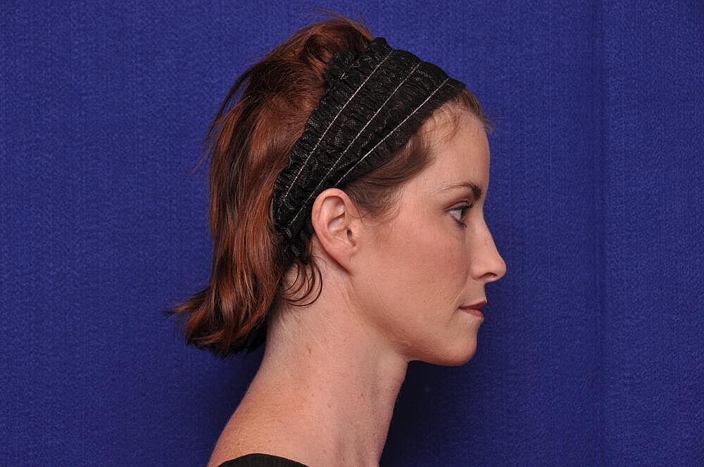 Liquid Facelift Before & After