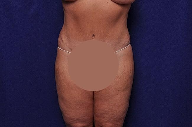 Body Lift Before & After