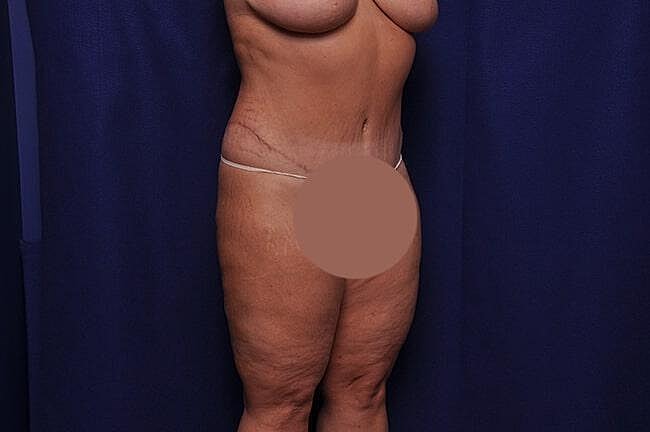 Body Lift Before & After