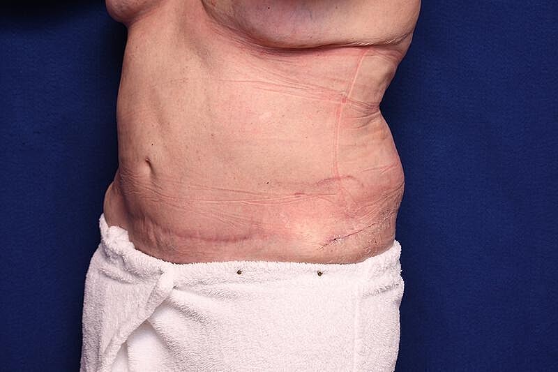 Body Lift Before & After