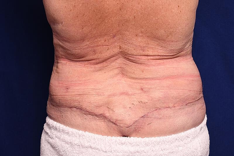 Body Lift Before & After