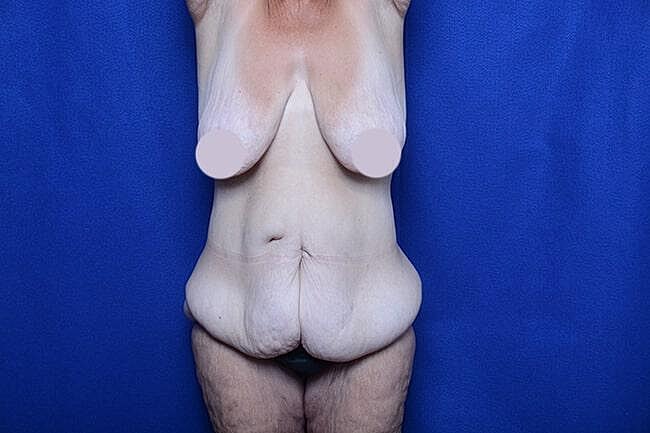 Body Lift Before & After