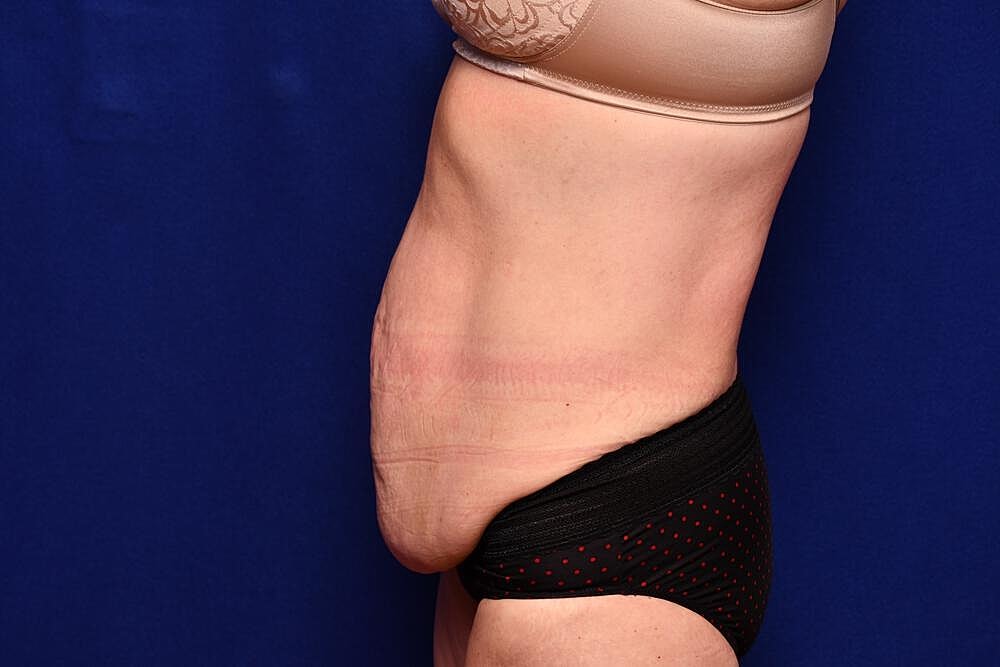 Body Lift Before & After